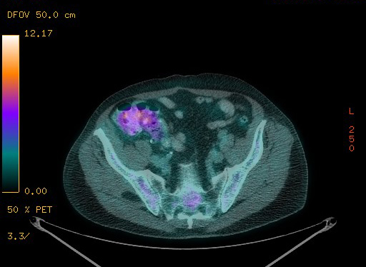 Appendiceal adenocarcinoma complicated by retroperitoneal abscess (Radiopaedia 58007-65041 Axial PET-CT 166).jpg