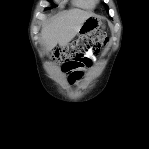 Appendicitis complicated by post-operative collection (Radiopaedia 35595-37113 B 11).jpg