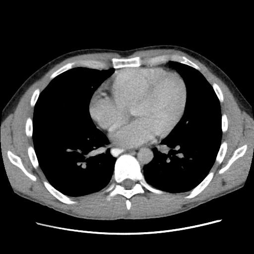 File:Appendicitis complicated by post-operative collection (Radiopaedia 35595-37114 A 2).jpg