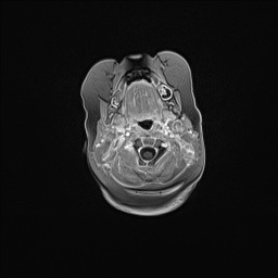 Aqueductal stenosis (Radiopaedia 73974-84802 Axial T1 C+ 24).jpg