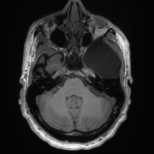 File:Arachnoid cyst with subdural hematoma (Radiopaedia 85892-101743 Axial T1 24).png