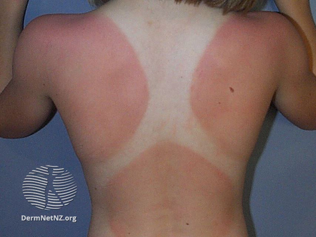 File:Around 4-7 days after exposure skin may start to peel and flake off. (DermNet NZ reactions-sunburn1).jpg