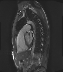 File:Arrhythmogenic right ventricular cardiomyopathy (Radiopaedia 57972-64966 Cine RVOT SSFP 25).jpg