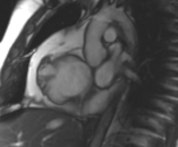 Arrhythmogenic right ventricular cardiomyopathy (Radiopaedia 69431-79307 Short axis cine 238).jpg