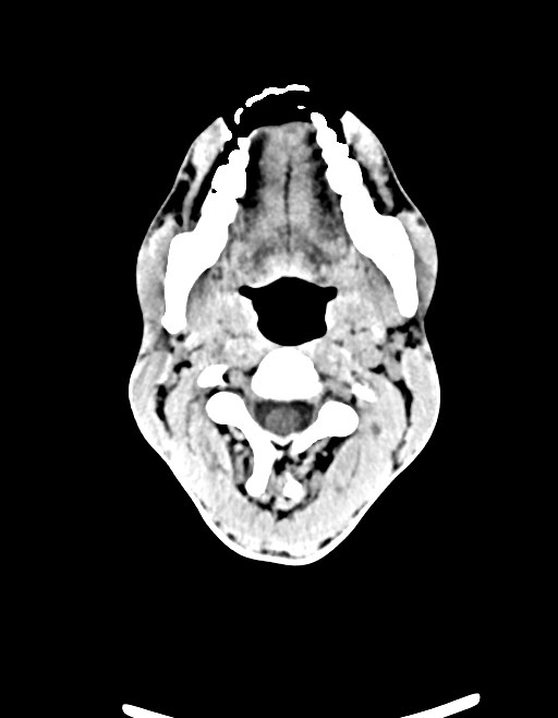 Arrow injury to the brain (Radiopaedia 72101-82607 Axial non-contrast 37).jpg