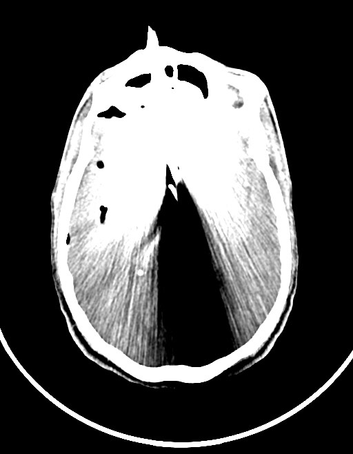 Arrow injury to the brain (Radiopaedia 72101-82607 Axial non-contrast 70).jpg