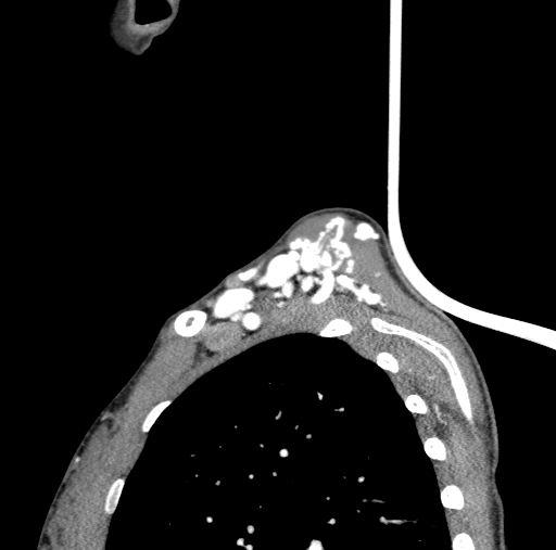 Arteriovenous malformation of the neck (Radiopaedia 53935-60062 C 3).jpg