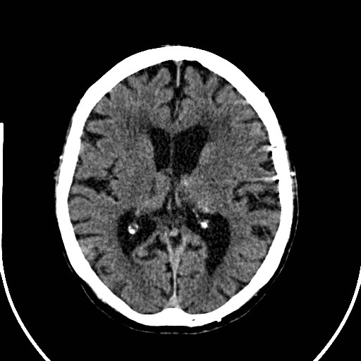 File:Artery of Percheron infarction (Radiopaedia 26307-26438 Axial non-contrast 24).jpg