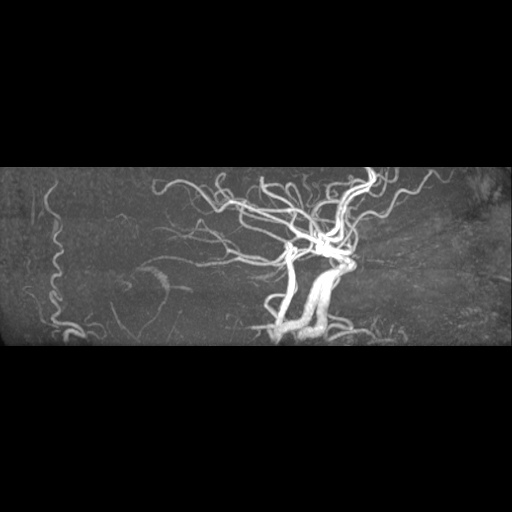 Artery of Percheron infarction (Radiopaedia 27975-28230 3D TOF 19).jpg