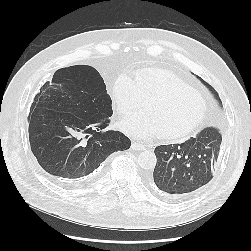 Asbestos-related pleural disease (Radiopaedia 74366-85250 Axial lung window 77).jpg