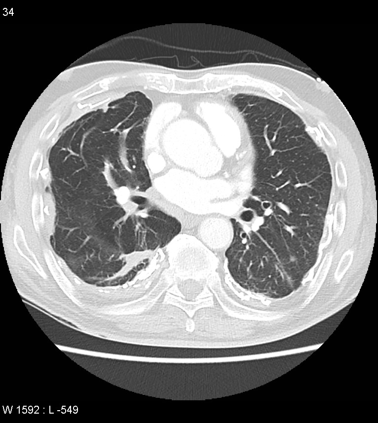 Asbestos related lung and pleural disease (Radiopaedia 14377-14301 A 31).jpg