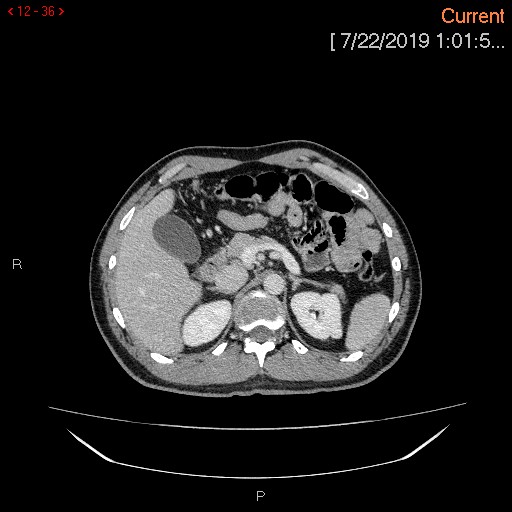 Ascending colonic diverticulum mimicking acute appendicitis (Radiopaedia 69943-80198 A 36).jpg