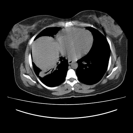 File:Ascending retrocecal appendicitis with liver abscesses (Radiopaedia 60066-67615 Axial non-contrast 2).jpg