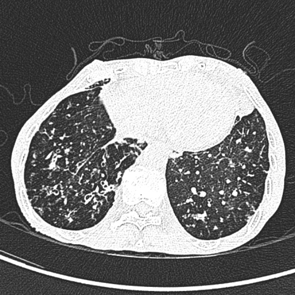 File:Aspergilloma- with Monod sign (Radiopaedia 44737-48532 Axial lung window 222).jpg