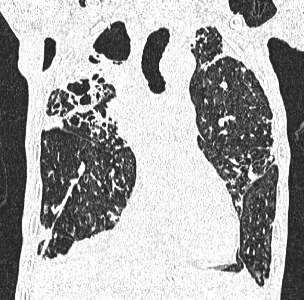 Aspergilloma- with Monod sign (Radiopaedia 44737-48532 Coronal lung window 223).jpg
