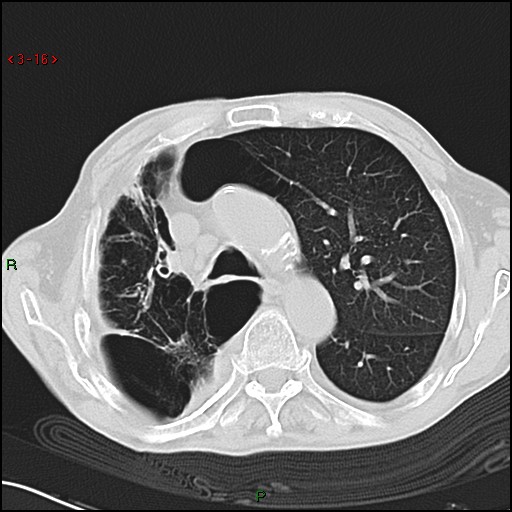 File:Aspergilloma (Radiopaedia 14842-14787 Axial lung window 16).jpg