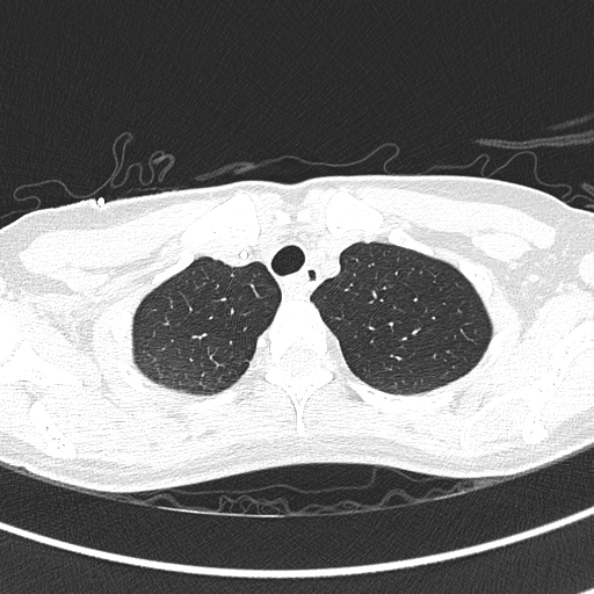 Aspergilloma (Radiopaedia 26223-26347 Axial lung window 13).jpg
