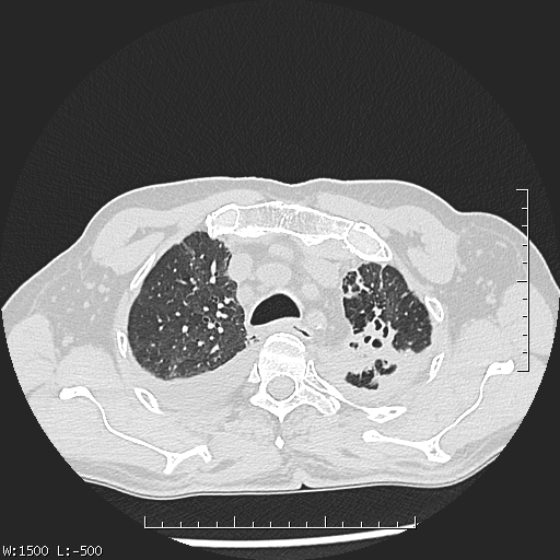 File:Aspergilloma (Radiopaedia 75184-86270 Axial lung window 11).jpg