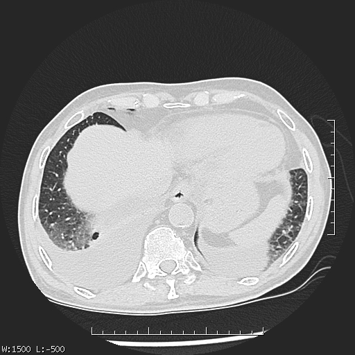 Aspergilloma (Radiopaedia 75184-86270 Axial lung window 45).jpg