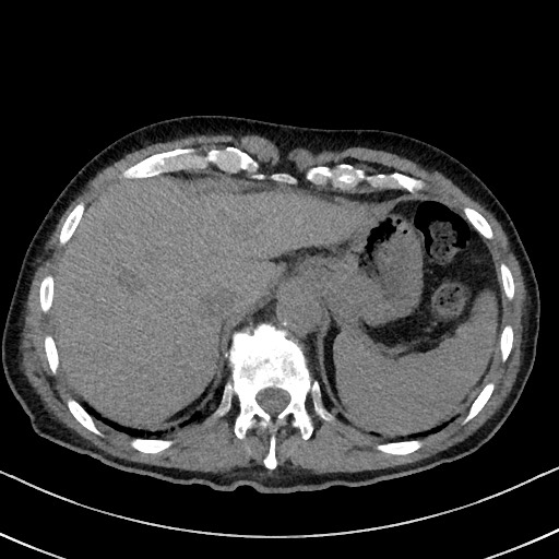 Aspergilloma on background pulmonary fibrosis (Radiopaedia 60942-68757 Axial non-contrast 52).jpg