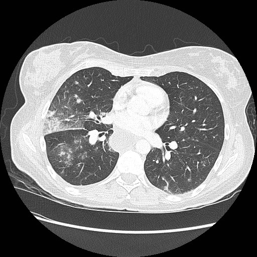 Aspiration pneumonia secondary to laparoscopic banding (Radiopaedia 18345-18183 lung window 58).jpg