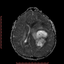 File:Astroblastoma (Radiopaedia 74287-85162 Axial ADC 39).jpg