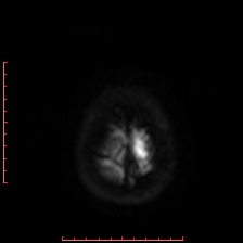 Astroblastoma (Radiopaedia 74287-85162 Axial DWI 106).jpg