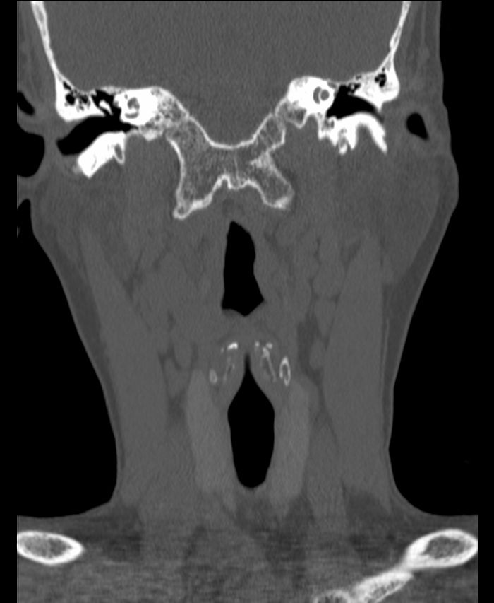 Atlanto-occipital assimilation with basilar invagination (Radiopaedia 70122-80188 Coronal bone window 41).jpg