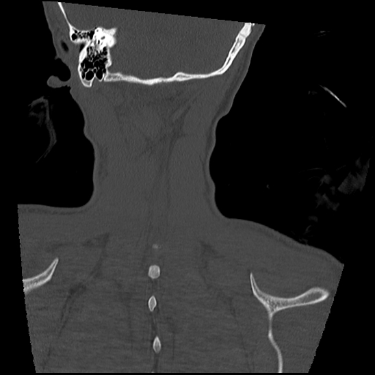 Atlanto-occipital dissociation (Traynelis type 1), C2 teardrop fracture, C6-7 facet joint dislocation (Radiopaedia 87655-104061 Coronal bone window 61).jpg