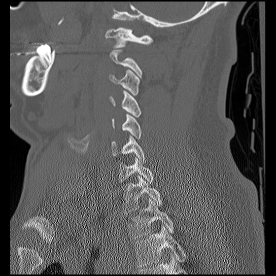 Atlanto-occipital dissociation injury (Radiopaedia 29274-29698 Sagittal bone window 39).png