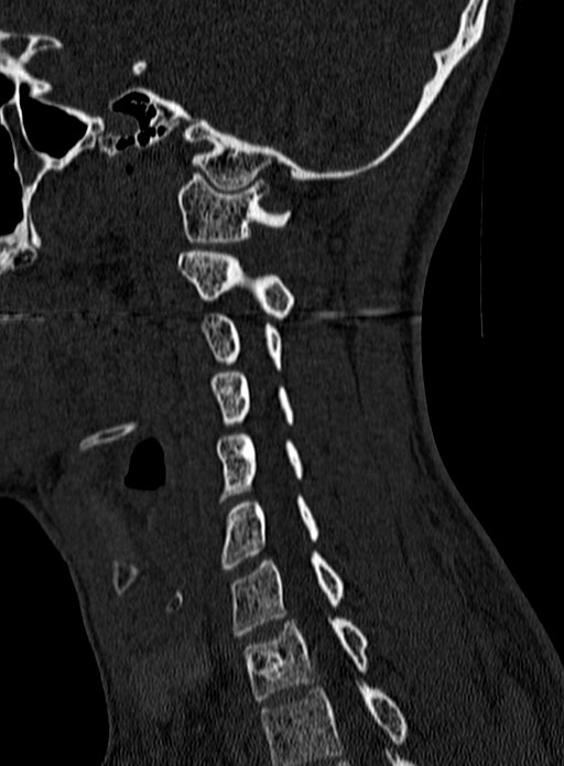 Atlantoaxial subluxation (Radiopaedia 44681-48450 Sagittal bone window 112).jpg