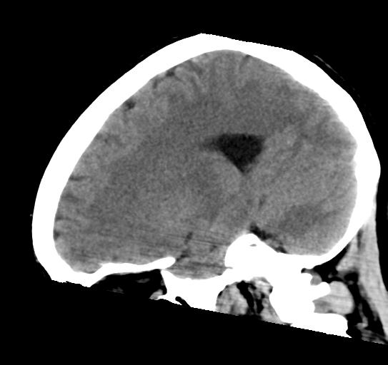 File:Atretic encephalocoele with inferior vermis hypoplasia (Radiopaedia 30443-31107 C 11).jpg