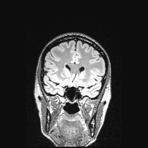Atretic encephalocoele with inferior vermis hypoplasia (Radiopaedia 30443-31108 Coronal FLAIR 125).jpg