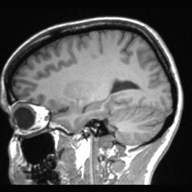 Atretic encephalocoele with inferior vermis hypoplasia (Radiopaedia 30443-31108 Sagittal T1 92).jpg