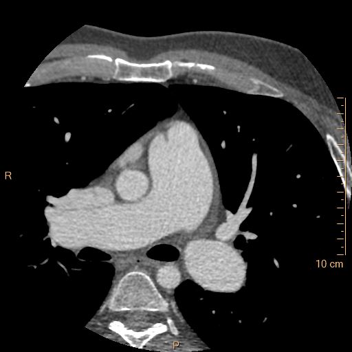 Atrial septal defect (upper sinus venosus type) with partial anomalous pulmonary venous return into superior vena cava (Radiopaedia 73228-83961 A 67).jpg