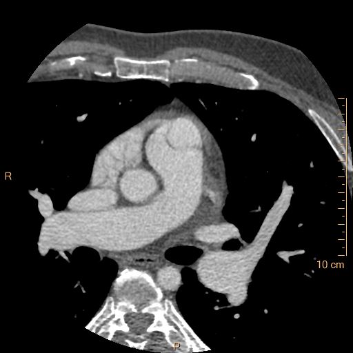 File:Atrial septal defect (upper sinus venosus type) with partial anomalous pulmonary venous return into superior vena cava (Radiopaedia 73228-83961 A 80).jpg