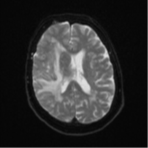 Atypical meningioma (WHO Grade II) (Radiopaedia 54742-60979 Axial DWI 17).png