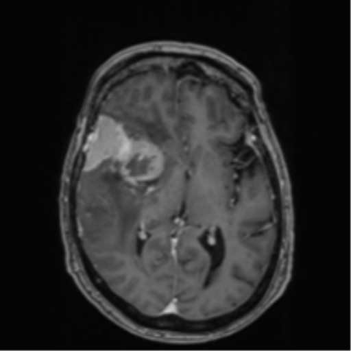 Atypical meningioma (WHO Grade II) (Radiopaedia 54742-60979 Axial T1 C+ 32).png