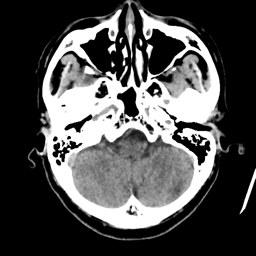 Atypical meningioma (WHO grade II) with osseous invasion (Radiopaedia 53654-59715 Axial non-contrast 12).png