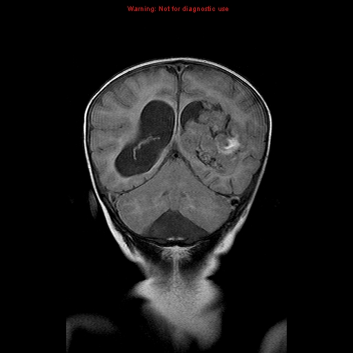 File:Atypical teratoid rhabdoid tumor (Radiopaedia 10712-11183 Coronal FLAIR 7).jpg