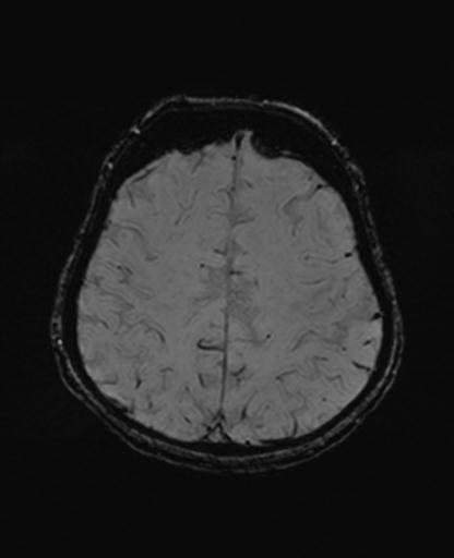 Autoimmune limbic encephalitis (Radiopaedia 30363-31005 SWI 59).jpg