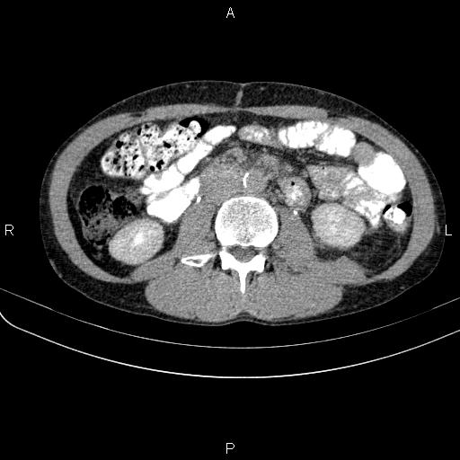 File:Autoimmune pancreatitis (Radiopaedia 84925-100431 Axial C+ delayed 42).jpg
