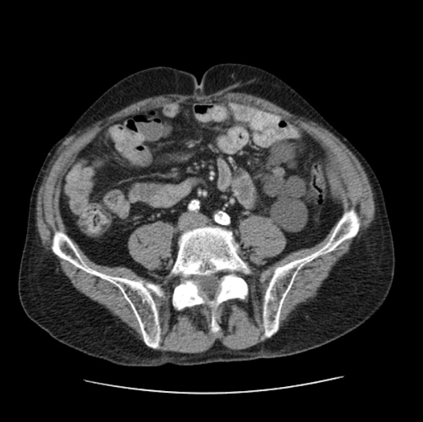Autosomal dominant polycystic kidney disease (Radiopaedia 27851-28094 B 89).jpg