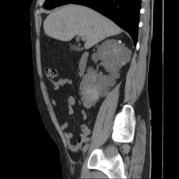 File:Autosomal dominant polycystic kidney disease (Radiopaedia 36539-38101 D 30).jpg