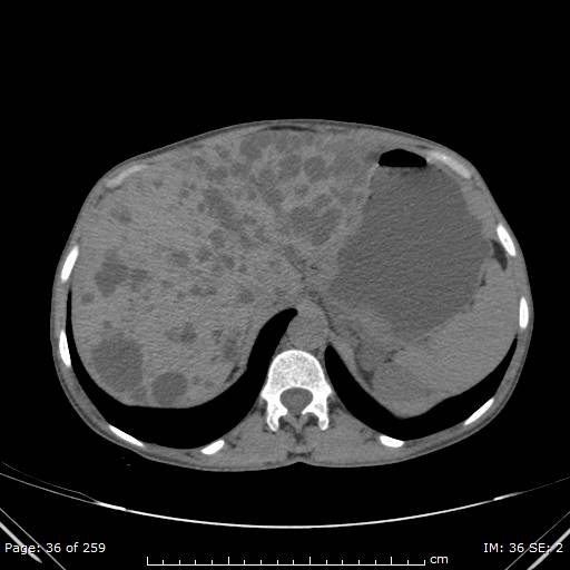 File:Autosomal dominant polycystic kidney disease (Radiopaedia 44122-47684 Axial 69).jpg