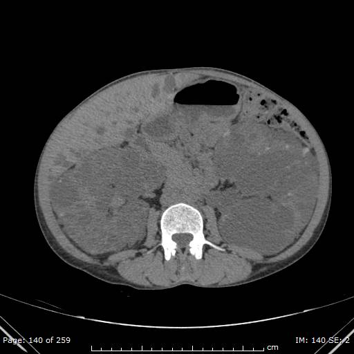Autosomal dominant polycystic kidney disease (Radiopaedia 44122-47684 Axial non-contrast 50).jpg