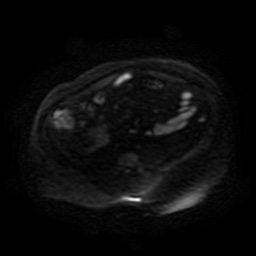 Autosomal dominant polycystic kidney disease (Radiopaedia 50259-55611 Axial DWI 70).jpg