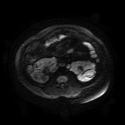 File:Autosomal dominant polycystic kidney disease (Radiopaedia 50259-55611 Axial DWI 98).jpg