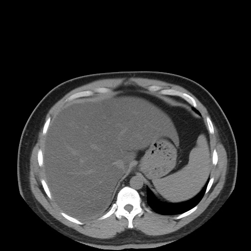 Autosomal dominant polycystic kidney disease (Radiopaedia 50259-55612 Axial non-contrast 19).jpg