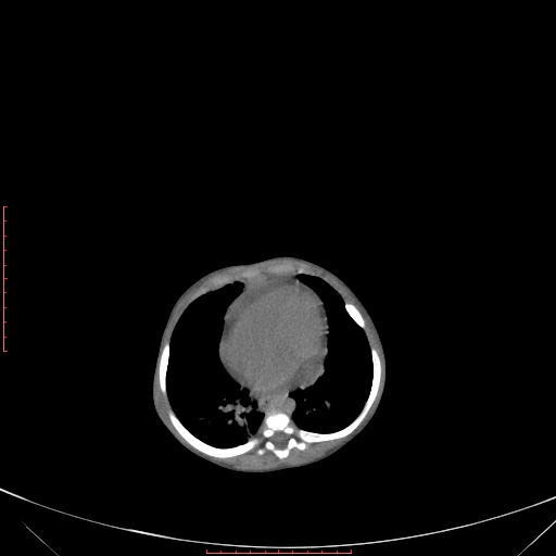 Autosomal recessive polycystic kidney disease associated with Caroli disease (Radiopaedia 61932-69984 Axial non-contrast 89).jpg